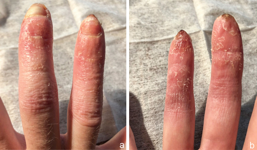 Heilung fingerkuppe abgetrennt Finger genäht